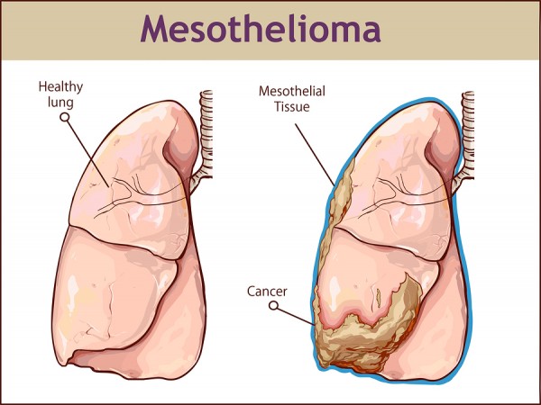 Mesothelioma is a Deadly Cancer and it’s Completely Preventable 3